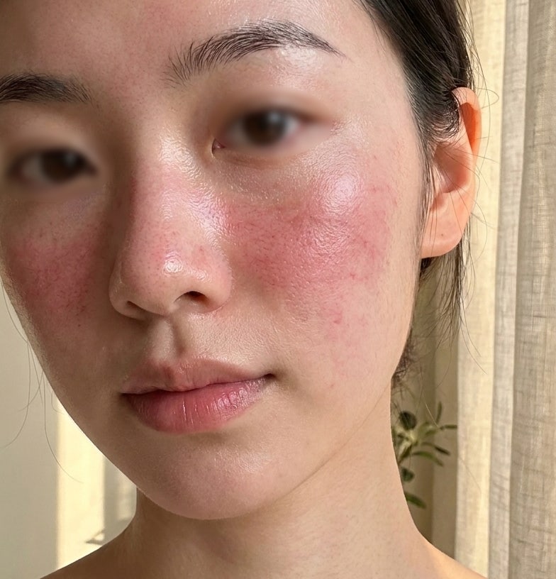 피부 홍조 없애는 법 붉은기 줄이는 피부 진정 관리법