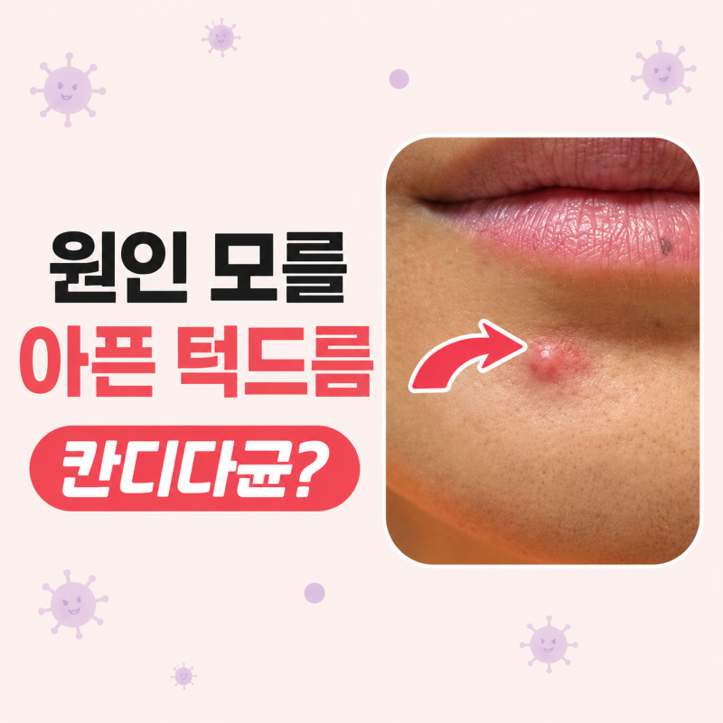 질염 칸디다균 턱 여드름 반복된 염증성 여드름 개인 경험