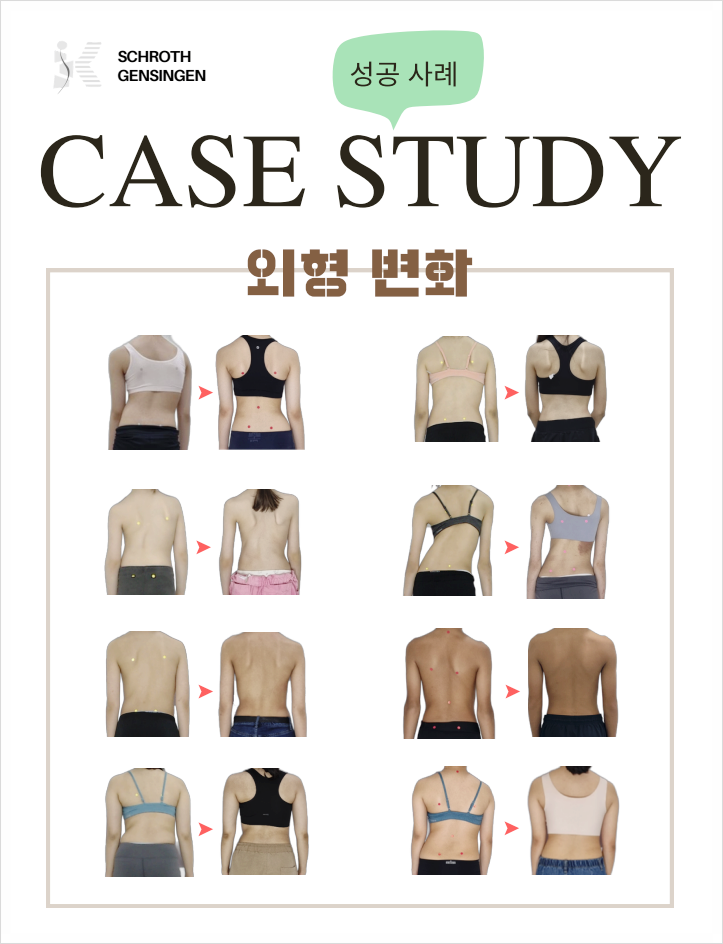 청소년 중학생 척추측만증, 수술 대신 3차원 K겐징겐 보조기 교정 가능할까?