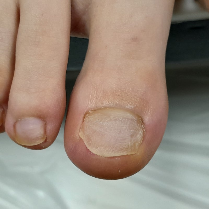 이렇게 심할 줄은... 일산 엄소아과의원에서 발톱무좀 케어받은 후기
