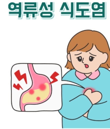 임산부 역류성식도염 속쓰림 약 복용법 주의사항 정리