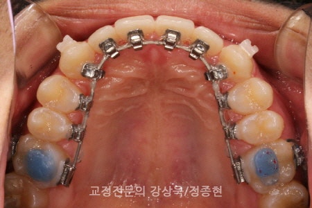 Non-Extraction Combination Orthodontic Treatment for Crowded Teeth [Busan Orthodontic Clinic]