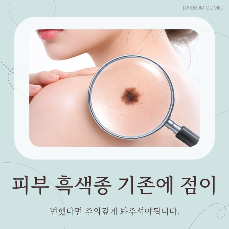 피부 흑색종 기존에 점이 변했다면 주의깊게 봐주셔야됩니다.