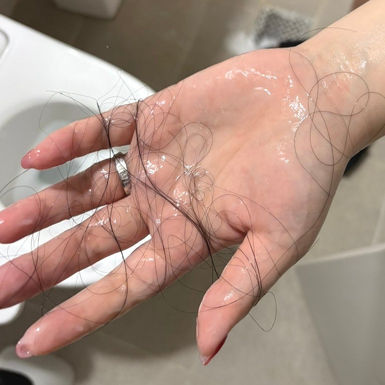 야즈부터 슬린다정까지 경구피임약 장기복용 후기 탈모 무월경 부작용 단약 후 변화