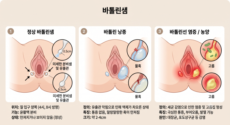 갑자기 발생한 외음부 불편감, 바톨린낭종이라는데 괜찮을까요?