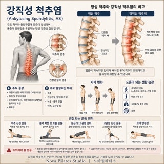국제 가이드라인으로 보는 강직성 척추염 운동