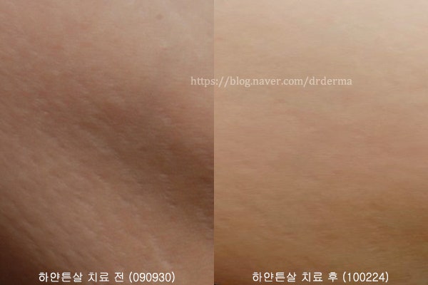 오래된 하얀튼살 없애는법, 효과적인 레이저 치료 접근 방식 핀홀법