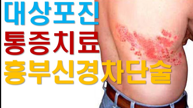늑골 통증인 줄 알았는데 대상포진? 밤잠 설친 옆구리 통증 늑간신경차단술 효과