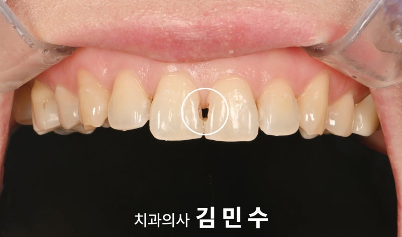 앞니 충치 치료, 블랙트라이앵글까지 한 번에 해결이 되나요? 바이오클리어를 이용한 레진치....