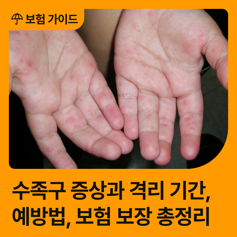 요즘 유행하는 수족구 질병코드, 초기 증상부터 예방법, 꼭 챙겨야 할 보험 보장 총정리!