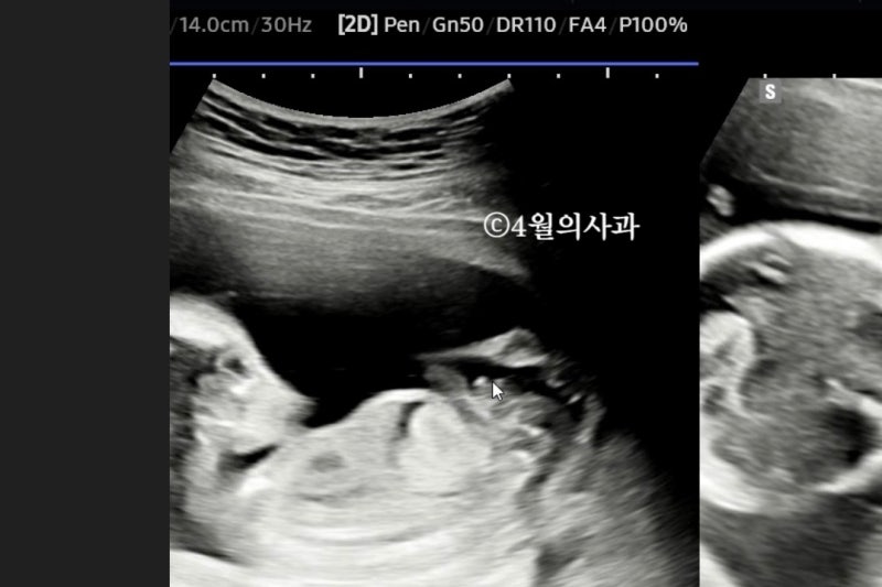 아기 성별 확인 시기, 16주 초음파 결과 및 2차 기형아 검사