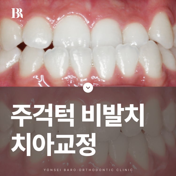 주걱턱인데 비발치 치아교정 가능할까요?