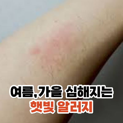 여름철 햇빛알러지 원인과 관리방법 3가지/피부병, 알레르기, 발진, 두드러기, 건강상식