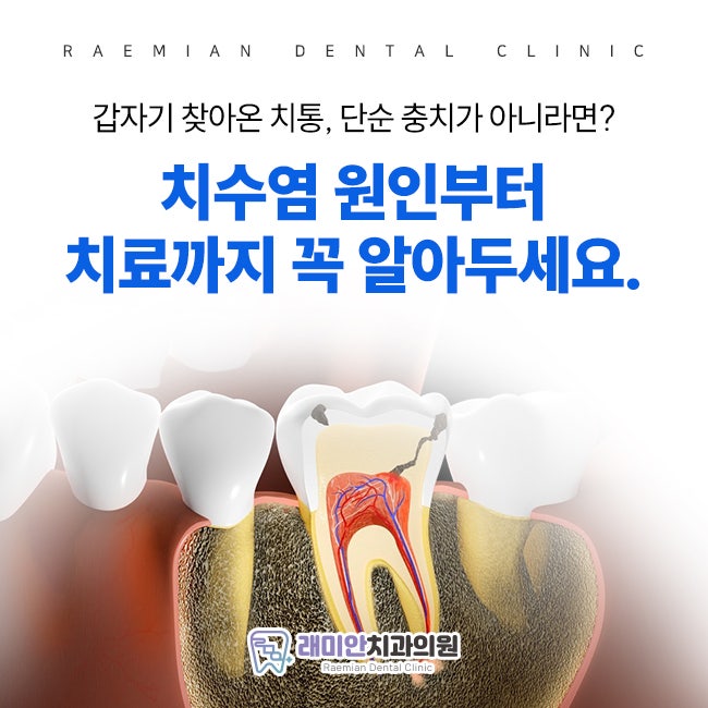 갑자기 찾아온 치통, 단순 충치가 아니라면? 치수염 원인부터 치료까지 꼭 알아두세요.