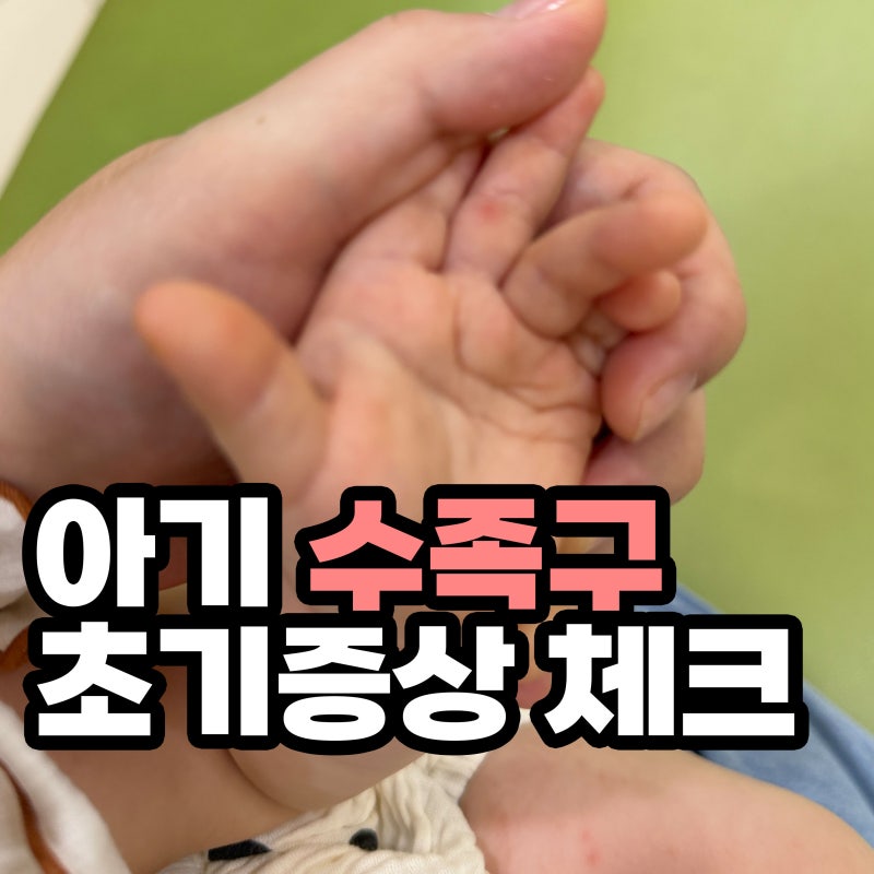 "빨간 점이 보인다면" 수족구 초기 증상, 감기와 다른 점은? 부모가 알아야할 신호