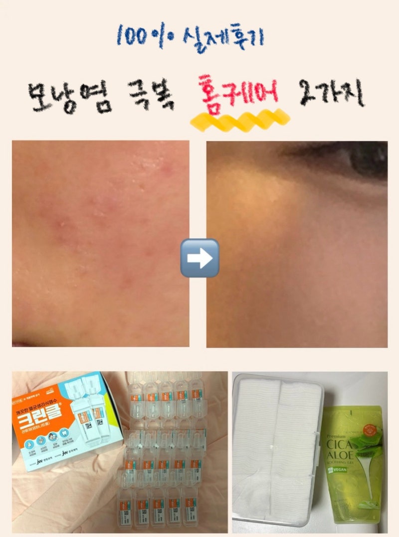 [ 모낭염 완벽 총정리판 ] (100% 실제후기) 모낭염 간단 홈케어 방법 / 모낭염 없애는 법 / 생리....