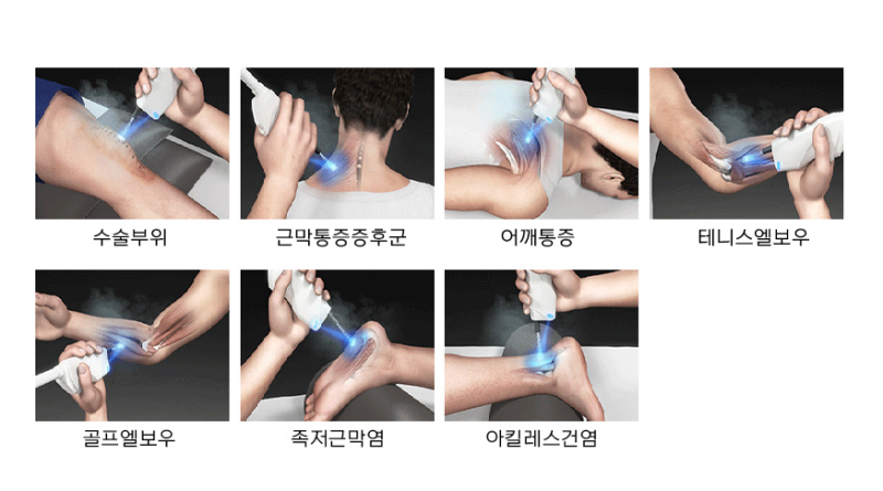 공릉역정형외과 급성 통증부터 만성 근육통까지 활용되는 냉각 재활신장분사치료