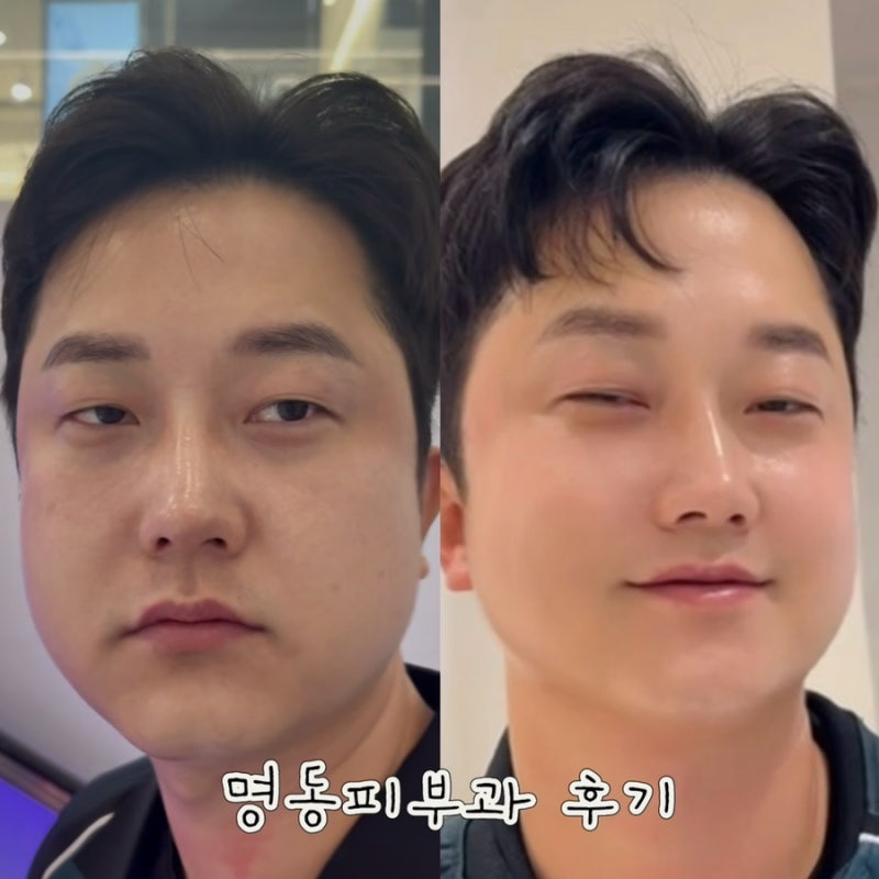 명동피부과 직장인 남자 온다리프팅 리니어지 꿀조합 보톡스 후기