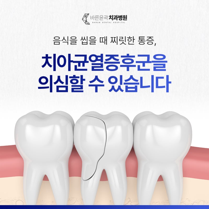 음식을 씹을 때 찌릿한 통증, 치아 균열 증후군을 의심할 수 있습니다