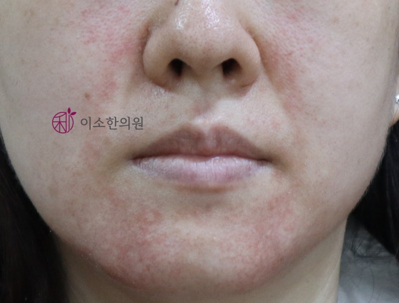 생리때마다 턱, 입 주변 붉어짐? 뾰루지가 아닌 이것! 창동역한의원