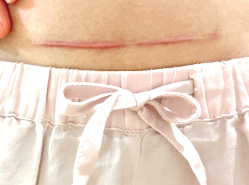 시카케어 겔시트 수술흉터밴드로 관리한 후기