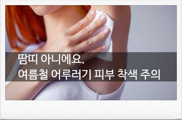 땀 많은 사람 필독! 어루러기 약국 연고 치료와 착색 방지 수칙 [여름피부 비상]