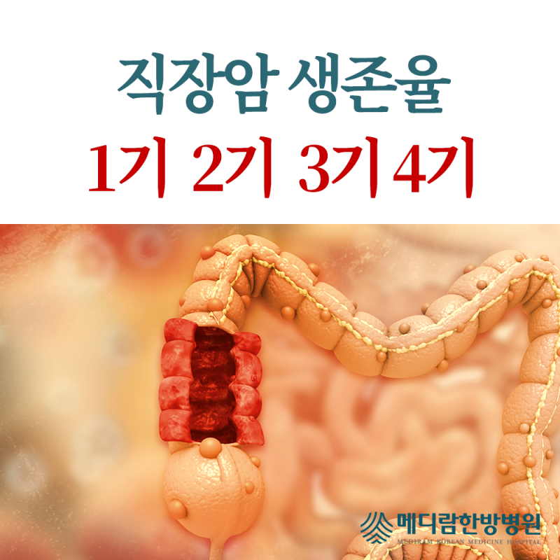 직장암 생존율 1기 2기 3기 4기, 완치 가능성 살펴보기