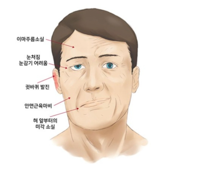 구안와사(口眼喎斜),벨마비 안면신경마비 증상,치료,관리 후기 (뇌졸증과 차이점)