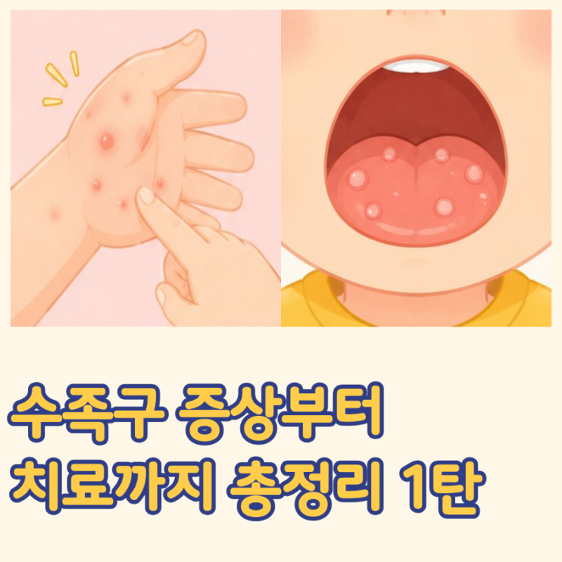 수족구란? 증상부터 전염, 병원, 치료까지 부모가 꼭 알아야 할 모든 것