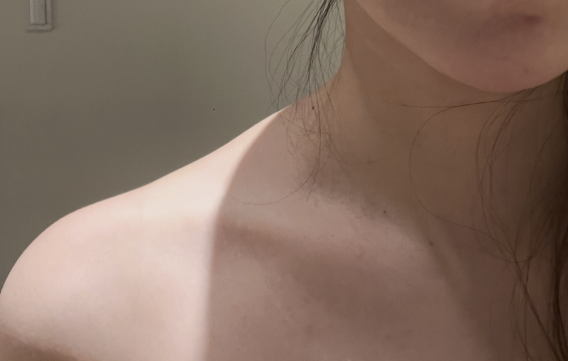 [웨딩준비4] 승모근 보톡스 솔직 후기(효과, 통증, 부작용)
