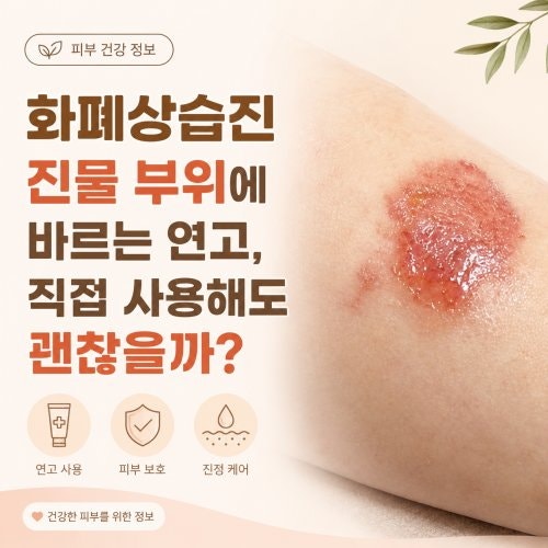 화폐상습진 진물 부위에 바르는 연고, 직접 사용해도 괜찮을까?