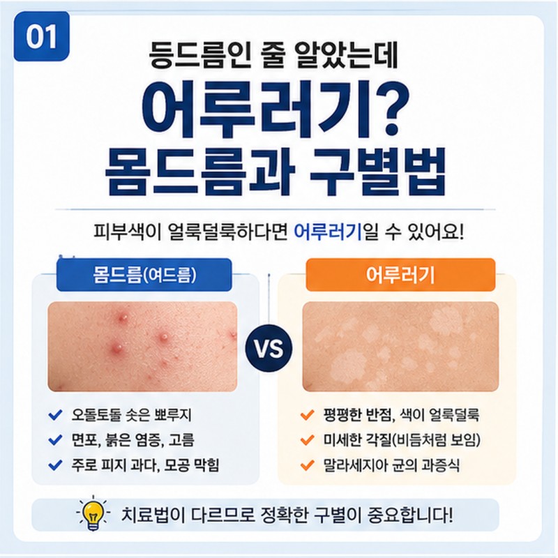 등드름인 줄 알았는데 어루러기? 몸드름과 구별법, 니조랄 사용법