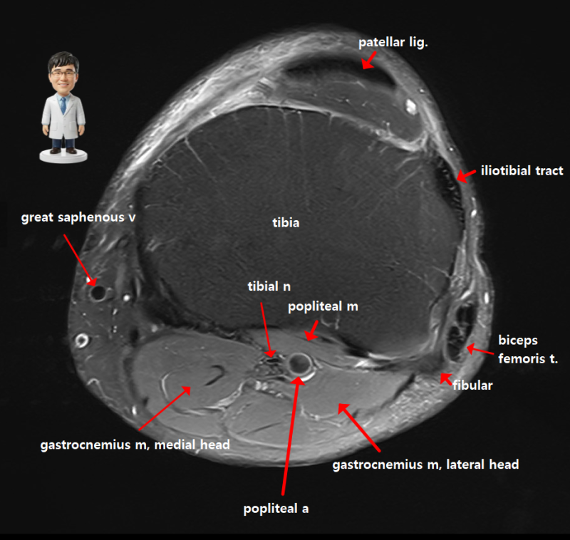 무릎 해부학과 MRI, 더 이상 두려워하지 마세요! 가장 쉽게 정복하는 꿀팁