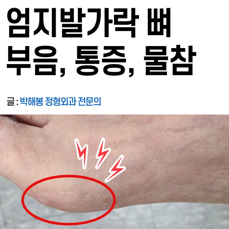 엄지발가락 부음, 통증 (관절염 치료방법)