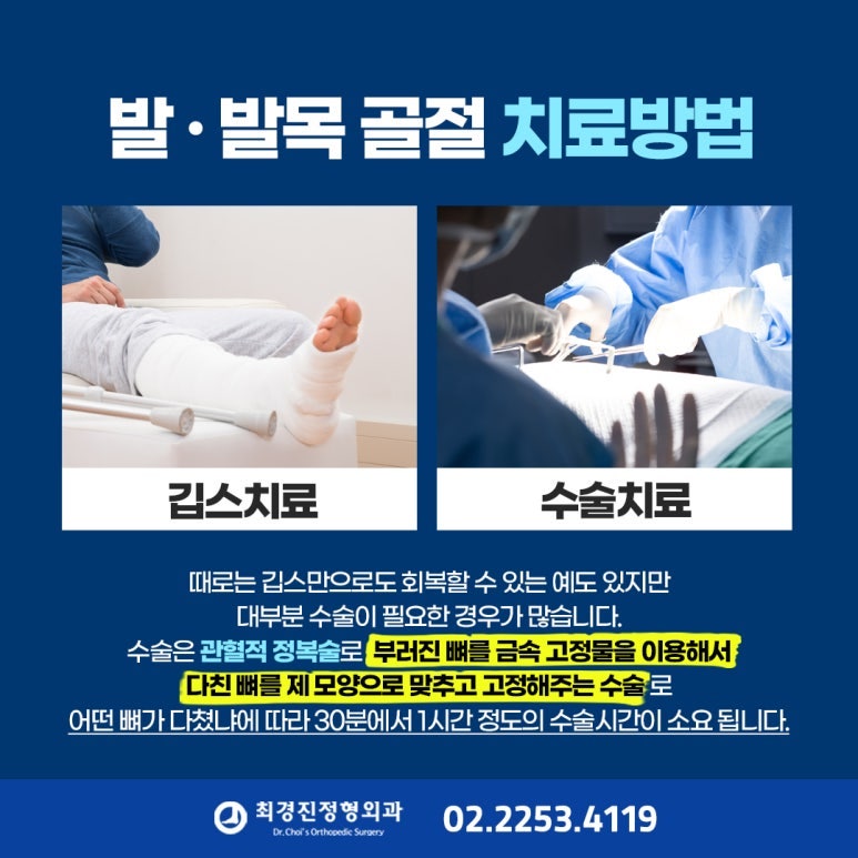 발목 골절, 언제부터 걸을 수 있을까? 발목골절 수술 후 회복기간과 재활운동
