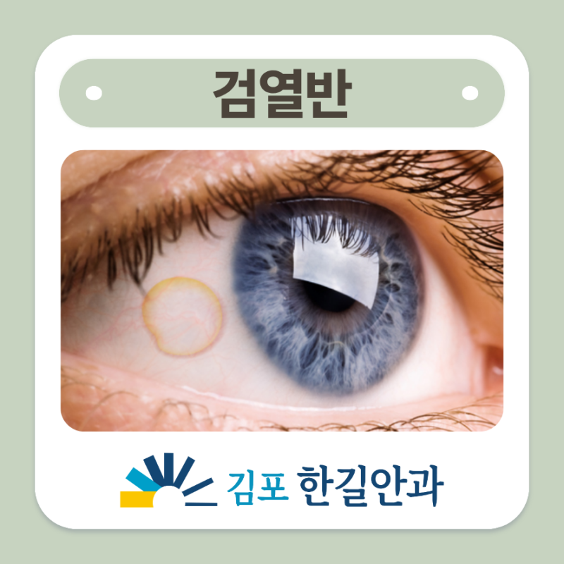 풍무동검열반 눈에 생긴 노란 돌출 그냥 두어도 될까요