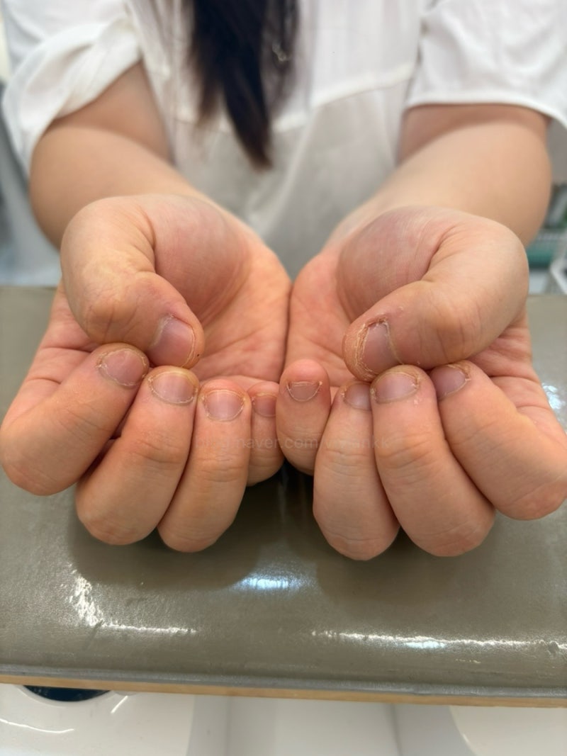 강남 압구정로데오 네일 물어뜯는손톱 교정 전문