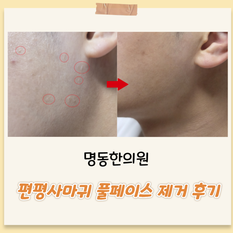 얼굴편평사마귀성지 명동한의원에서 풀페이스 제거하고온 후기
