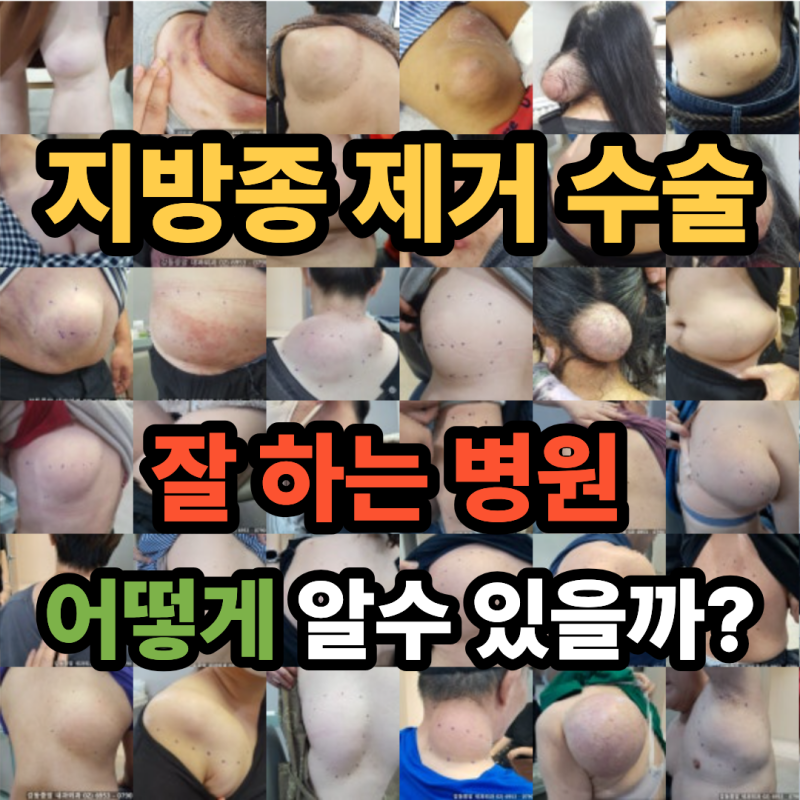 서울 지방종 제거수술 잘하는 병원 어떻게 알수있을까?