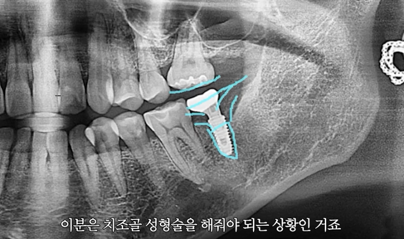 임플란트식립후통증, 식립 깊이가 중요한 이유는?