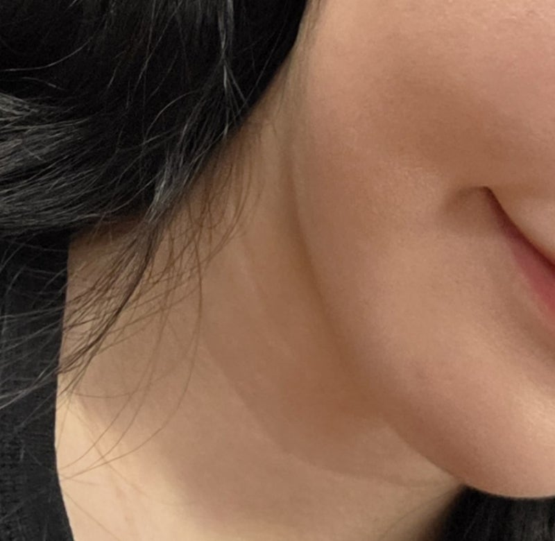목주름 패치 올킨스 실리콘 패치 후기__매년 필러 맞던 사람의 정착템 발견
