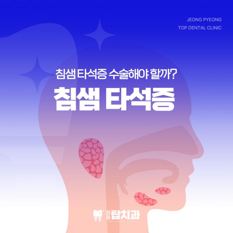 경산치과 : 침샘 타석증 증상 치료 방법 꼭 수술해야 할까?