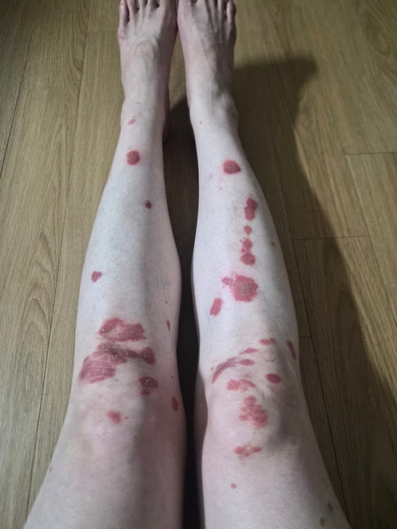건선 8년차 대학병원 첫 진료 (조직검사, 사이폴엔 처방)