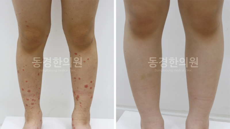 알레르기 자반증, 빨리 치료받아야 하는 이유 자반증 증상과 치료 방법