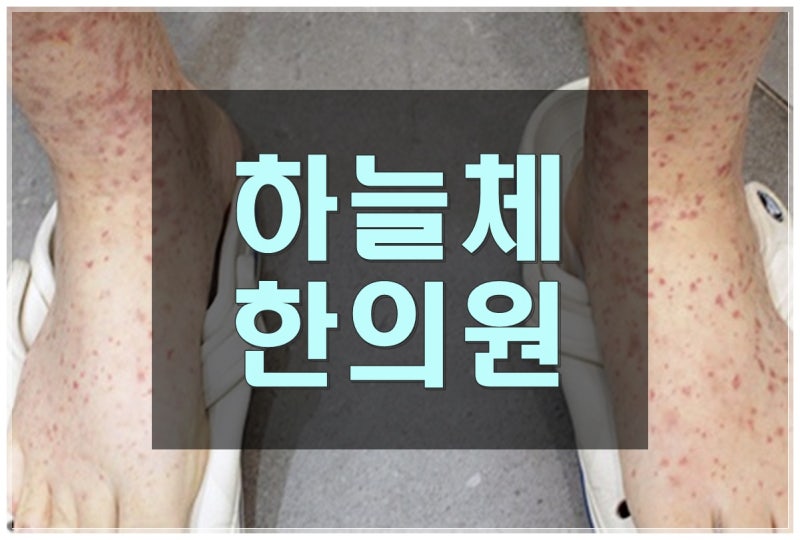 창원한의원 피부 자반증 증상 알려진 상식과 실제로 확인해야 하는 내용을