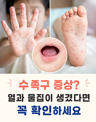 수족구 증상, 열과 물집이 생겼다면? 원인부터 치료·예방법까지 총정리