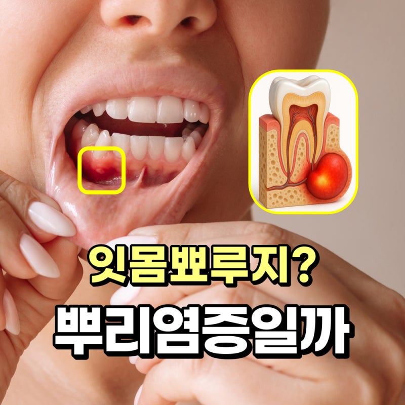 어금니통증, 잇몸에 뾰루지가 생겼다면 치아뿌리 염증일 수 있습니다