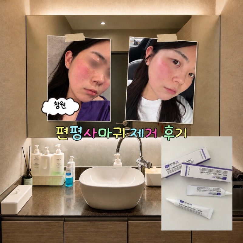 창원 편평사마귀 제거 후기｜어븀야그레이저 당일 · 3일 · 한달 경과 및 리터치 비교