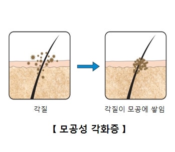 홈케어만으로 모공각화증 해결하는 방법(병원X, 시술X)