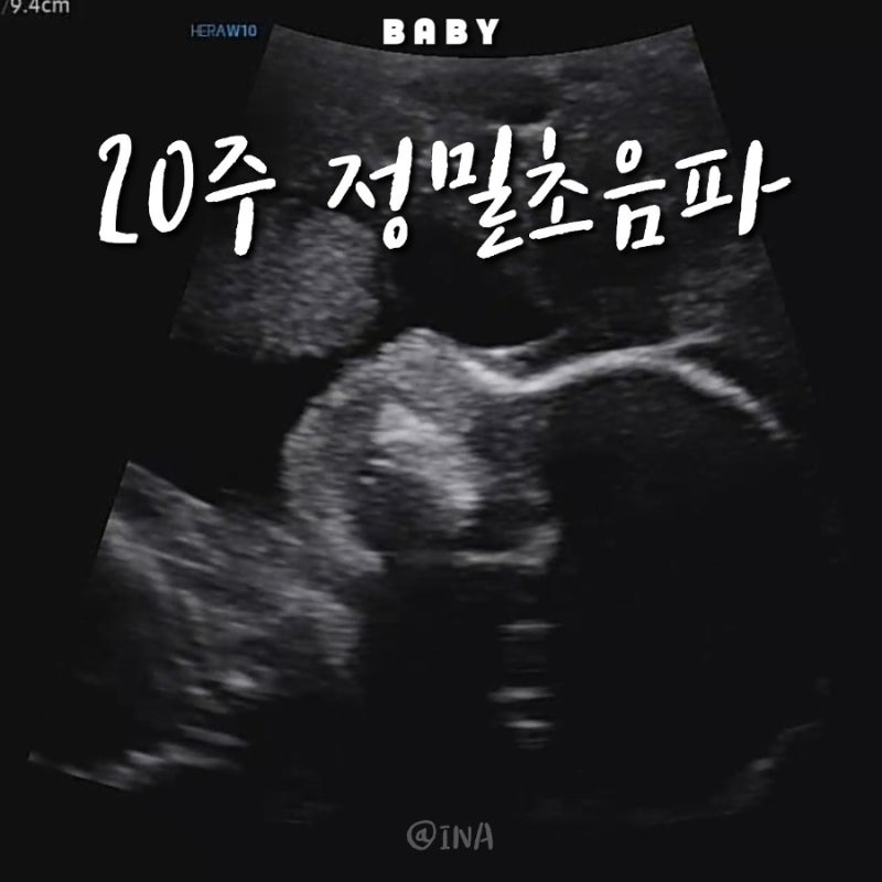 고령산모 다발성자궁근종 자연임신 20주 6일차 정밀 초음파 후기